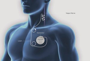 Diagram of components of a vagus nerve stimulation (VNS) device