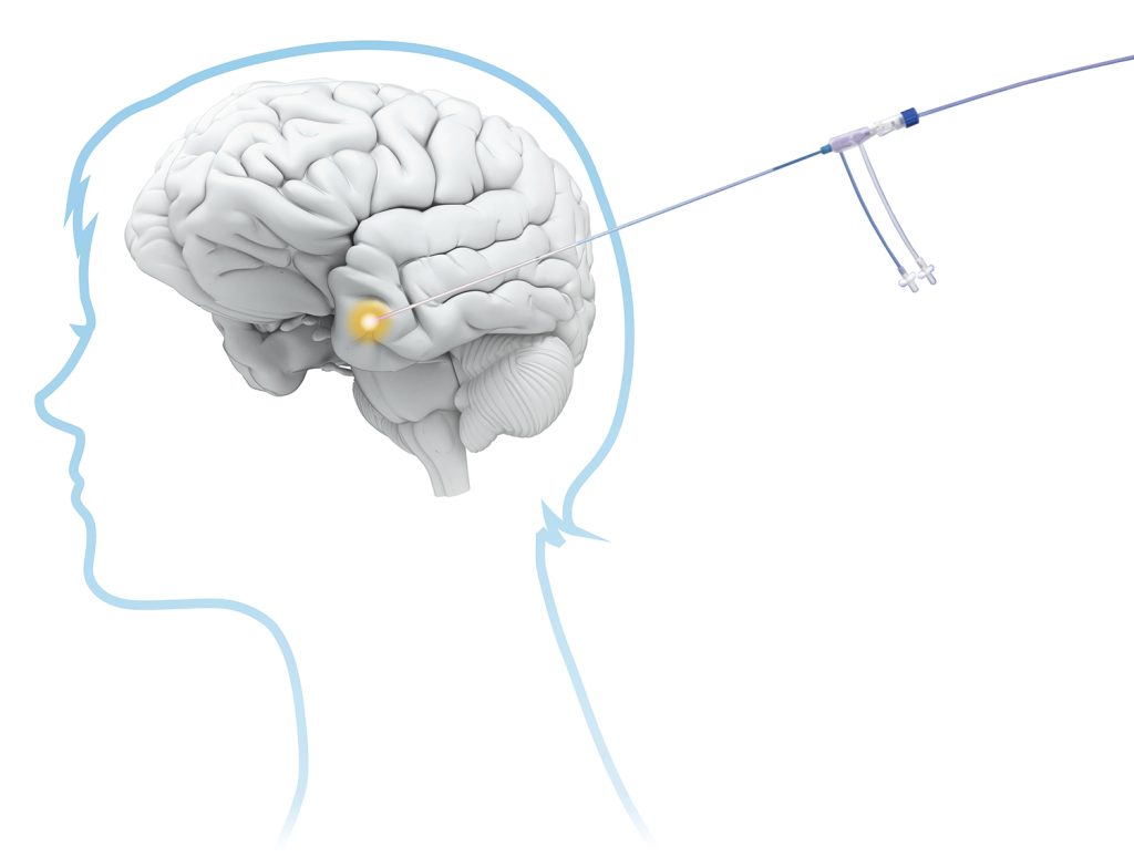 NHS launches laser beam brain surgery