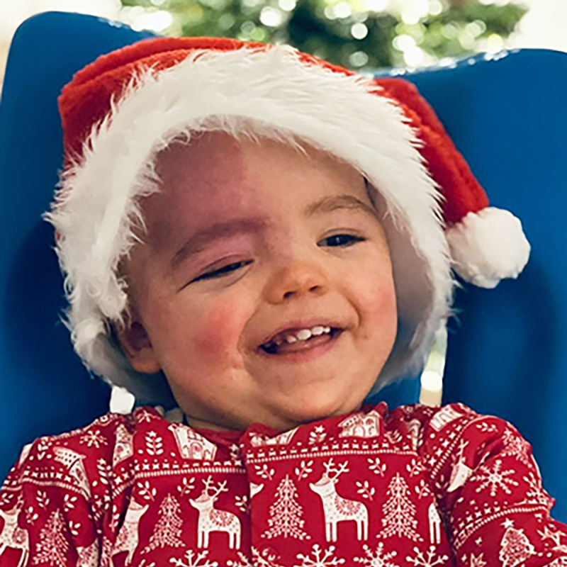 A young girl with Sturge-Weber syndrome smiling