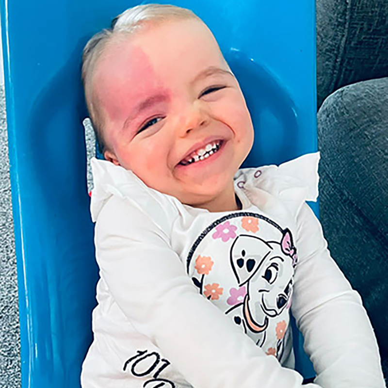 Young girl with Sturge-Weber syndrome smiling