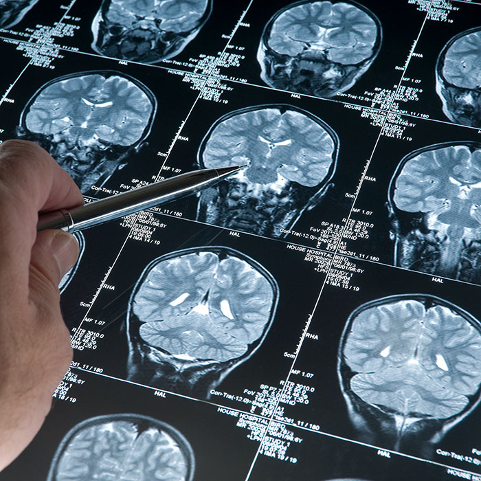Neurological conditions leading cause of illness – study