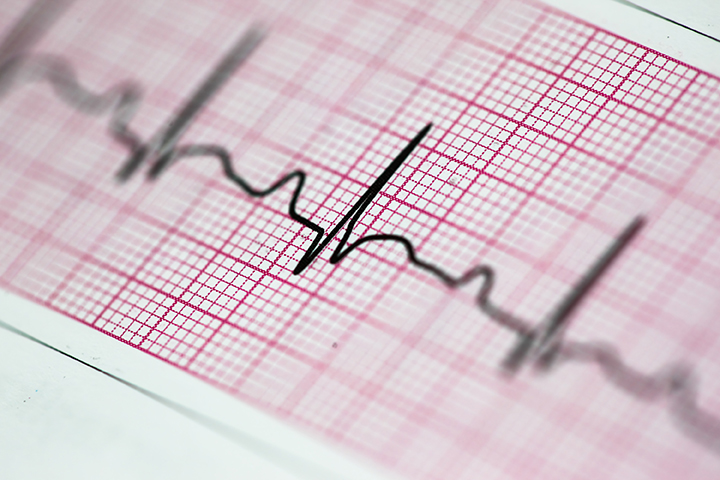 Heart problems in drug resistant epilepsy – study Heart problems in drug resistant epilepsy – study