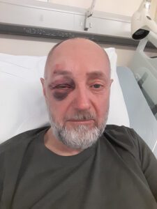 David on a hospital bed with a black eye following a seizure