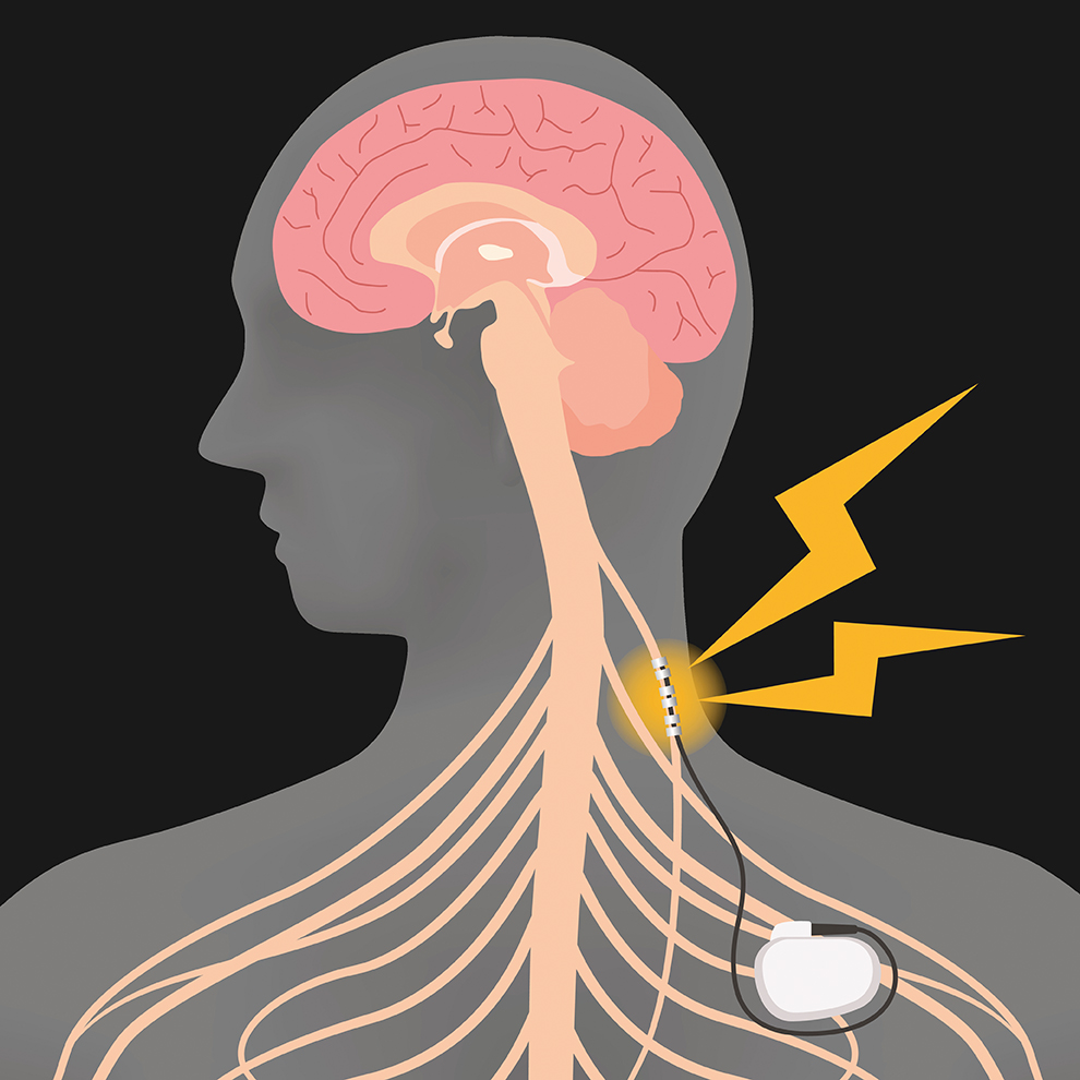 Trial investigating long-term VNS effectiveness launches Trial investigating long-term VNS effectiveness launches