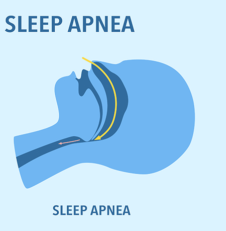 Epilepsy drug may treat sleep apnoea – and offer extra seizure support