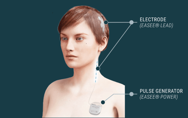 Diagram on a model showing the electrode (easee lead) positioned on the head, connected by the lead to the pulse generator (easee power) in the chest.